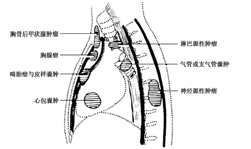 纵隔肿瘤好发部位