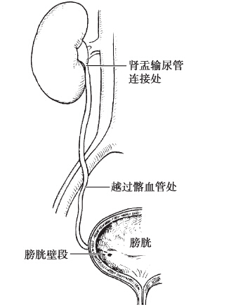 输尿管生理狭窄